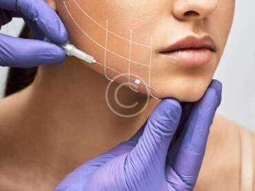 Correcting the lower third of your face with fillers post14-copyright