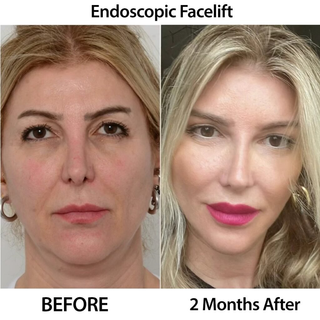 Endoscopic Facial Aesthetics